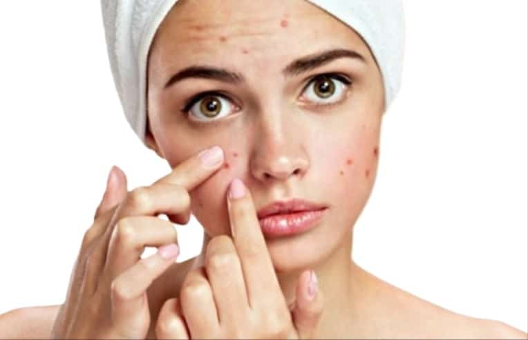 A person squeezing her pimples on her face for ways hormones impact skin